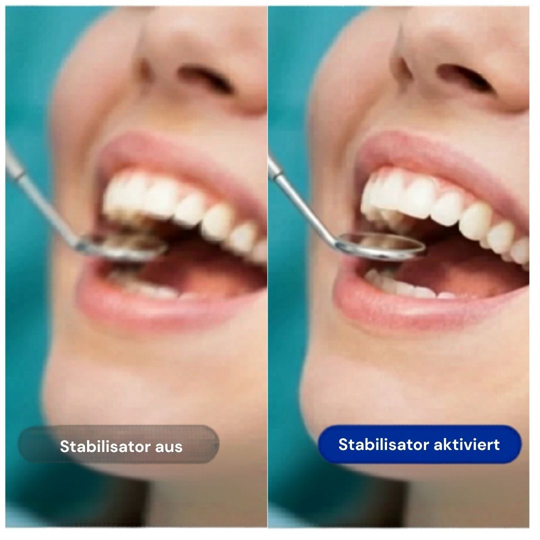 Bildstabilisierung im Vergleich: aus vs. ein — schärfere zahnmedizinische Aufnahme